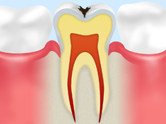 C1【エナメル質の虫歯】