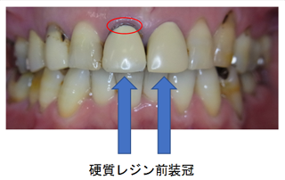 硬質レジン前装冠