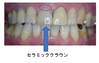 セラミッククラウン