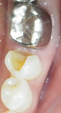 虫歯の除去・形成・型取り